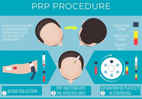 De Effectiviteit Van PRP Behandeling In Vergelijking Met DHI