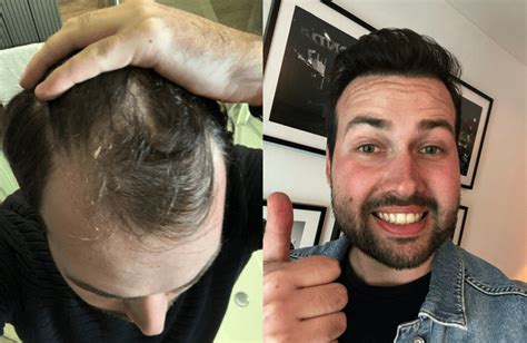 Haartransplantatie Bij Mannen: Een Complete Gids