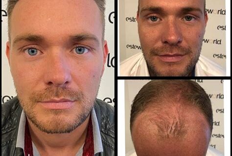 Haartransplantatie Mythes Ontkracht