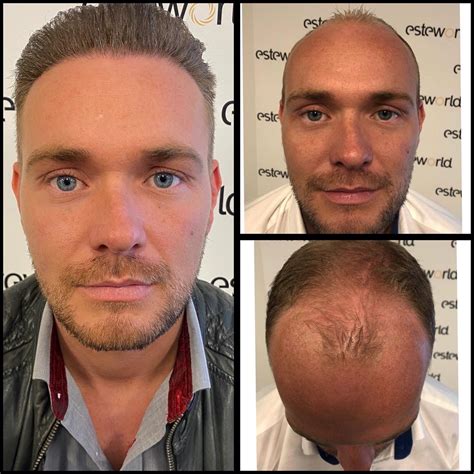 Haartransplantatie Mythes Ontkracht