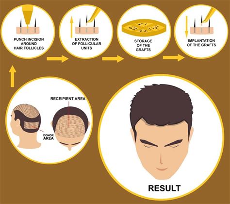 Haartransplantatie: De Geschiedenis Achter De Methode