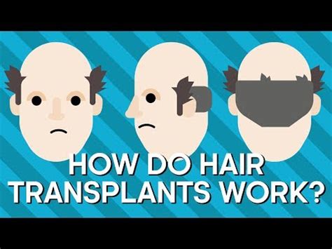 Haartransplantatie: Hoe Het Proces U Kan Helpen