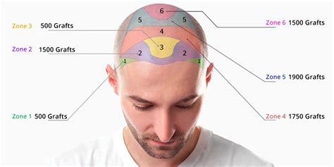 Haartransplantatie Kosten: Wat Zegt De Markt?