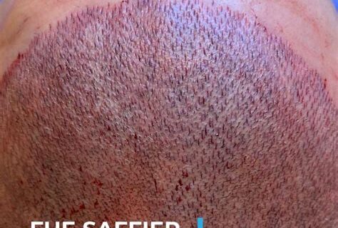 Haartransplantatie Saffier FUE: Veiligheid En Effectiviteit