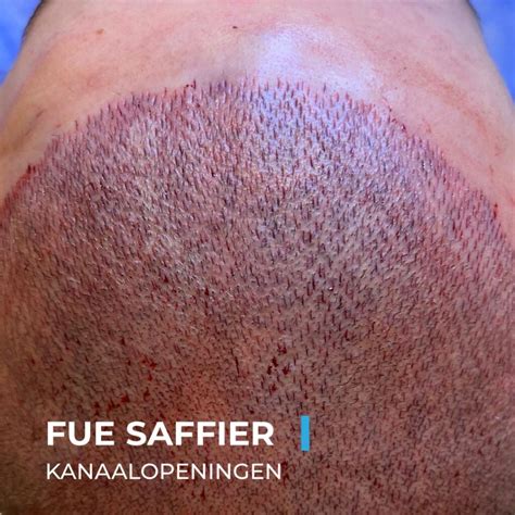 Haartransplantatie Saffier FUE: Veiligheid En Effectiviteit