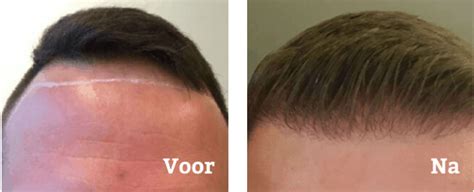 Wat Is De Hersteltijd Na Een Haartransplantatie?