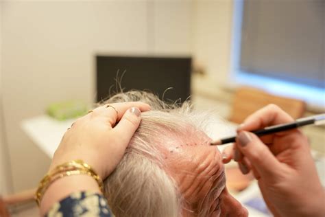 Behandelingen Voor Haarverlies: Wanneer Haartransplantatie?