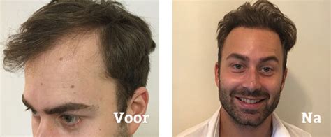 Haartransplantatie Kosten: Hoe Te Vergelijken Tussen Klinieken