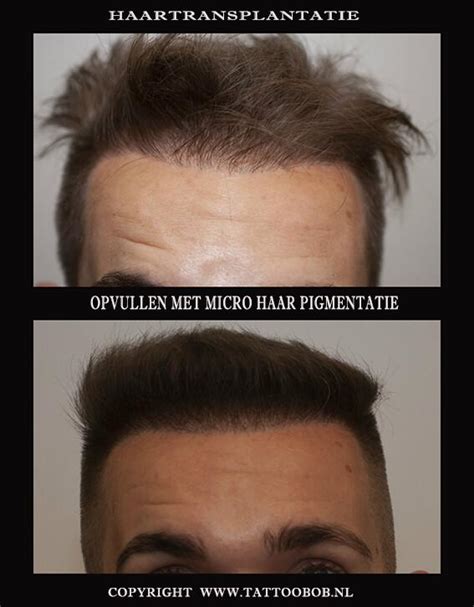 Haartransplantatie Met Eigen Haar Vs. Kunstmatig Haar