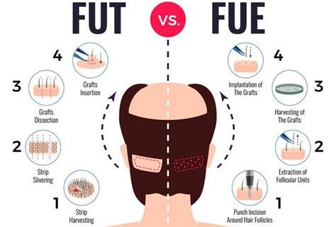 Populaire Haartransplantatie Technieken