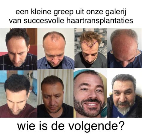 Voorbereiding Op Je Haartransplantatie: Do's En Don'ts