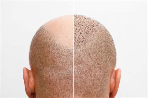 De Beste Nazorg Na Een Haartransplantatie