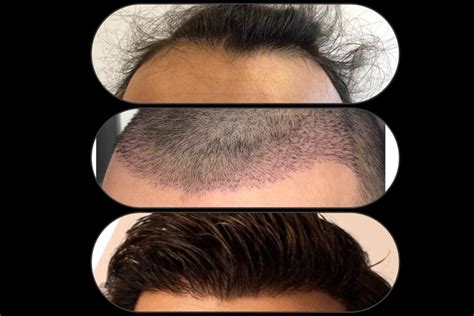 Saffier FUE: De Technologie Achter De Nieuwe Haartransplantaties