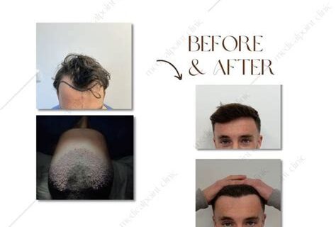 Wat Te Verwachten Tijdens Een Haartransplantatie Procedure