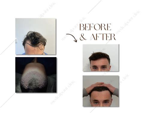 Wat Te Verwachten Tijdens Een Haartransplantatie Procedure